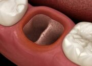 Arti Mimpi Cabut Gigi Geraham Bawah ke Dokter Menurut Islam: Apa Artinya di Balik Mimpi Medis Ini?